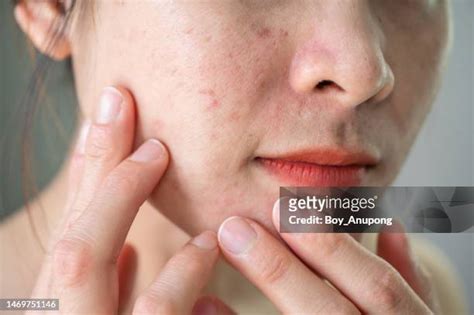 皮膚病照片|25,241 皮膚病 Stock Photos, High